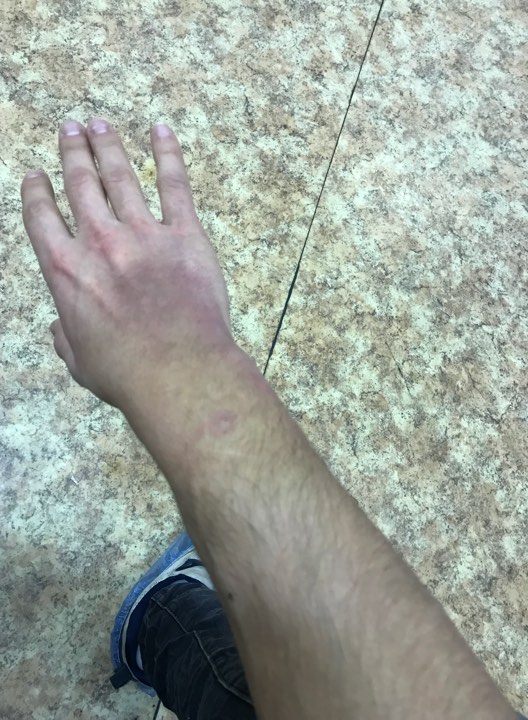Рука еще восстанавливается после отборочного заезда в Польше Рука еще восстанавливается после отборочного заезда в Польше