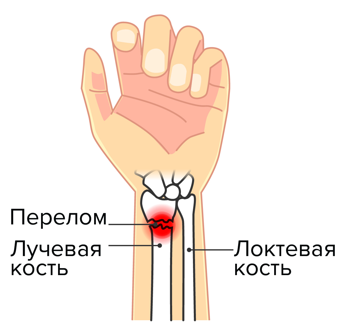 Перелом лучевой кости Перелом лучевой кости