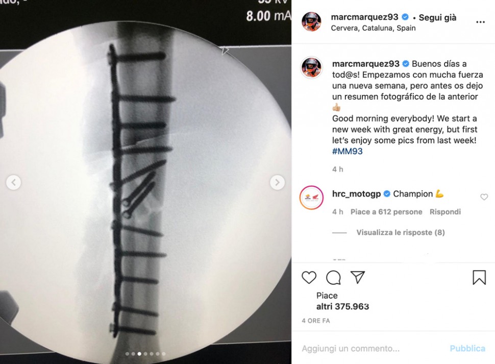 Рентгенограмма перелома Марка Маркеса на Гран-При Испании