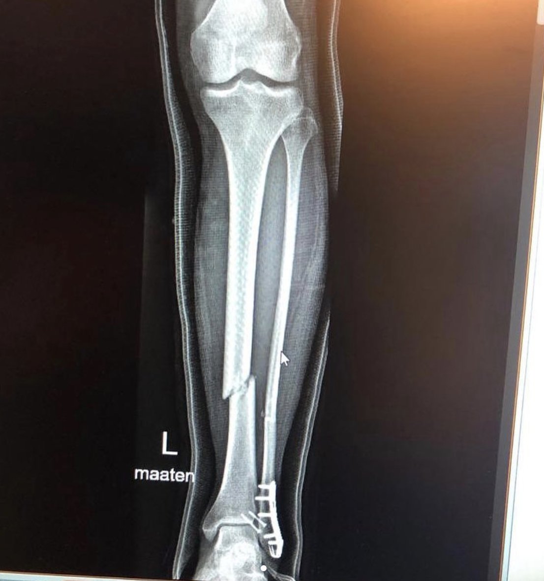 Свежий рентгеновский снимок: на ближайшие 40-50 дней Мика Каллио выбывает из программы KTM