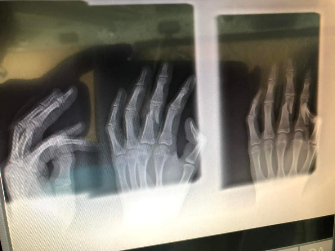 Рентген Лиама Эвертса - сломаны два пальца на левой руке